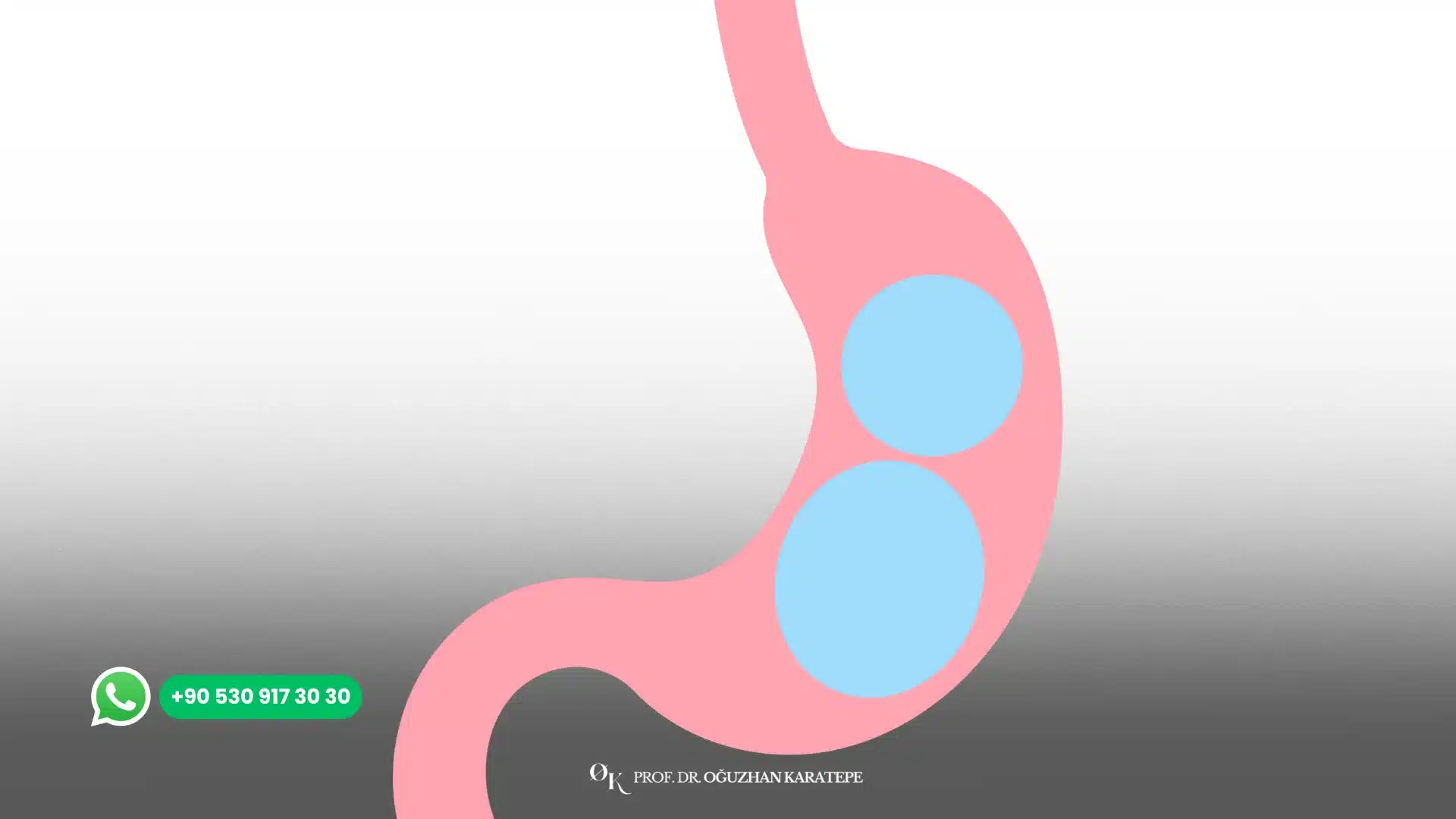 Gastric balloon procedure for non-surgical weight loss