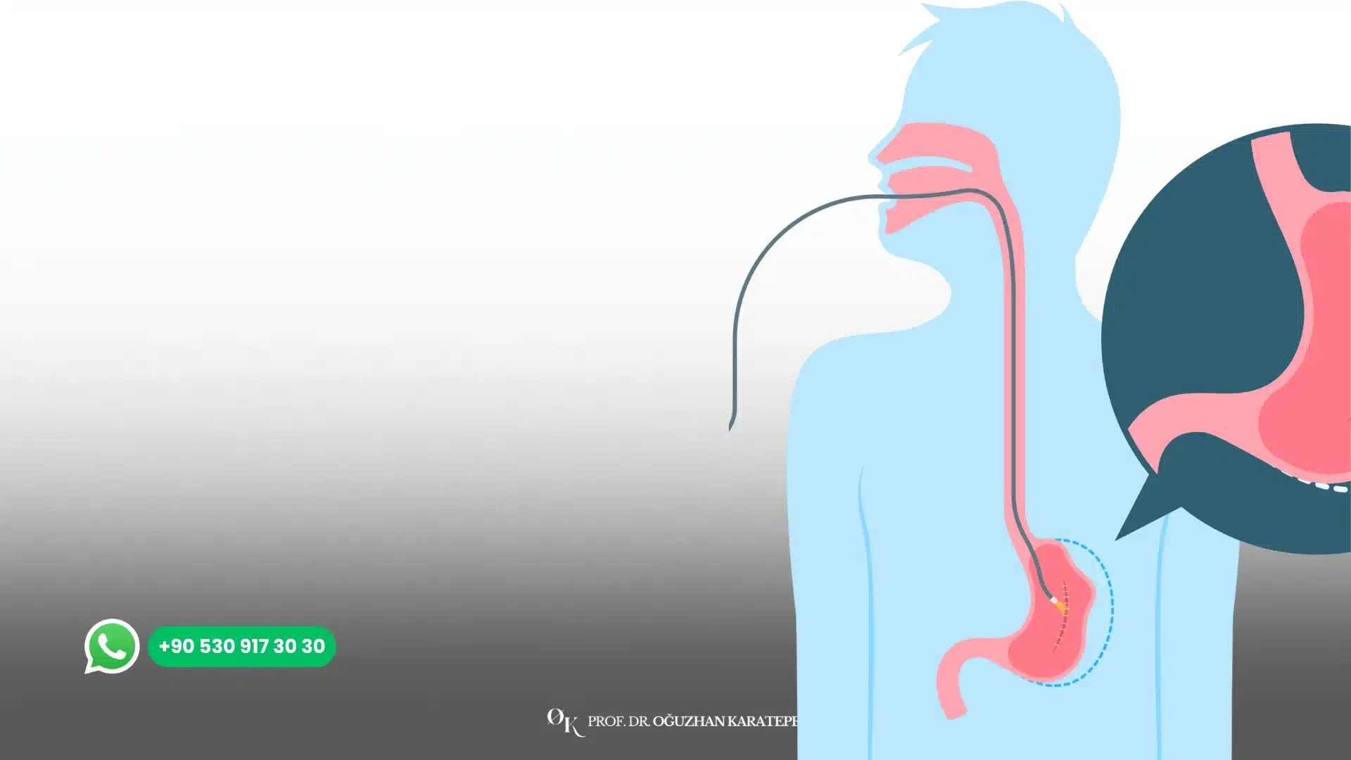 Gastric Balloon Before and After Results | Patient Stories