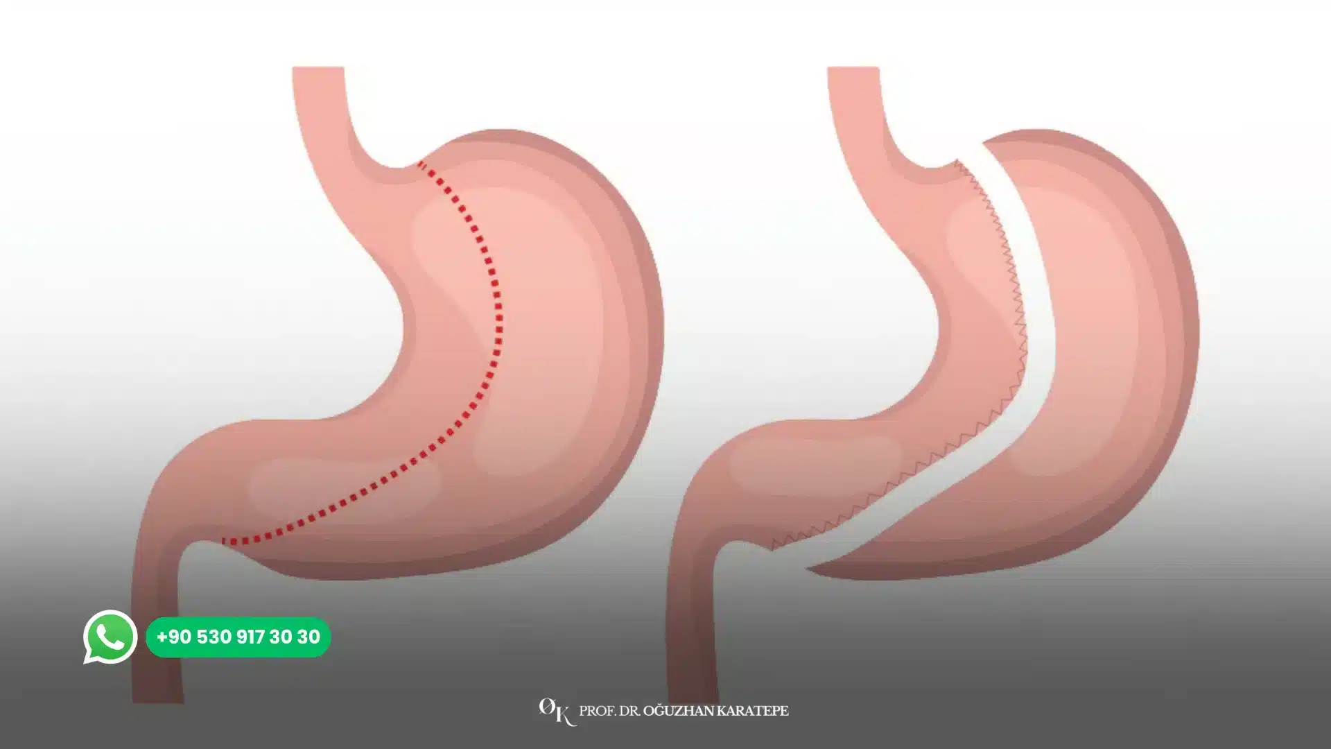 Safe gastric sleeve surgery techniques