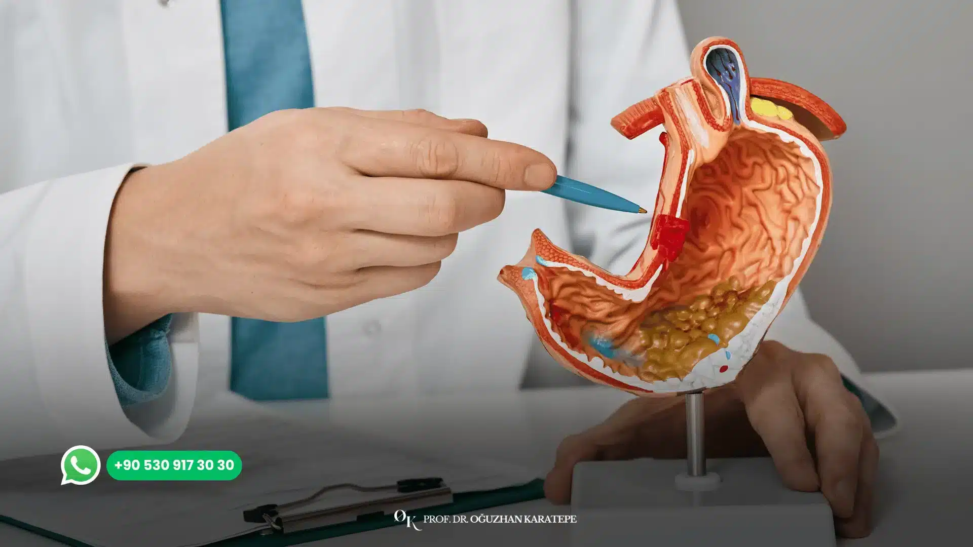 Weight control through gastric sleeve