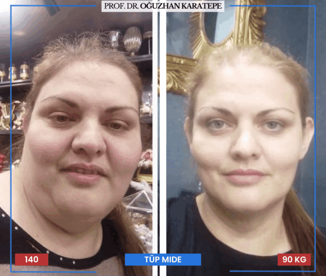 Obezite Cerrahisi Öncesi ve Sonrası – Tüp Mide Yorumlar Tüp mide ameliyatı öncesi sonrası fotoğrafları ve hasta yorumları