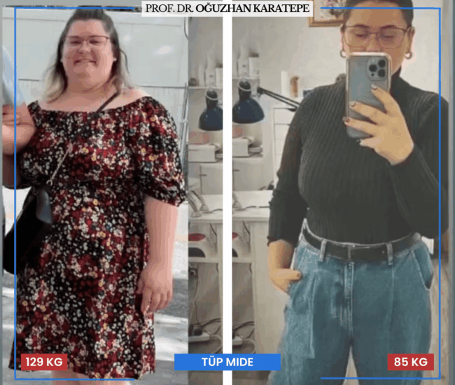 Tüp Mide Ameliyatı Sonrası Yorumlar ve Şikayetler Tüp mide ameliyatı sonrası zayıflayan hastaların yorumları ve şikayetleri