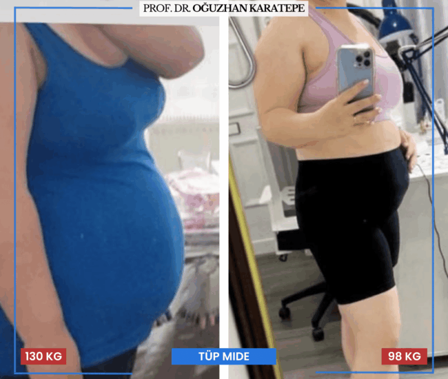 Obezite ve Tüp Mide Ameliyatı Öncesi Sonrası Değişim Obezite ameliyatı öncesi sonrası karşılaştırma ve hasta deneyimleri