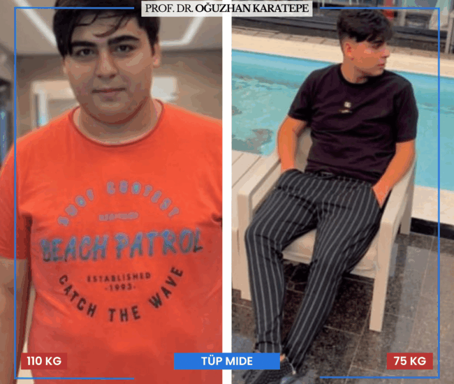 Tüp Mide Ameliyatı Yorumları – Gerçek Deneyimler Tüp mide ameliyatı hakkında en güncel hasta yorumları