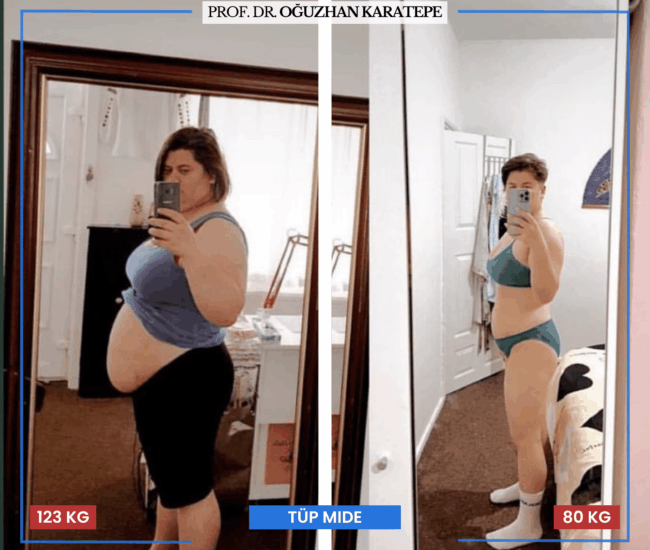 Obezite Ameliyatı Sonrası Şikayetler Nelerdir? Tüp mide ameliyatı sonrası oluşan şikayetler ve çözüm önerileri