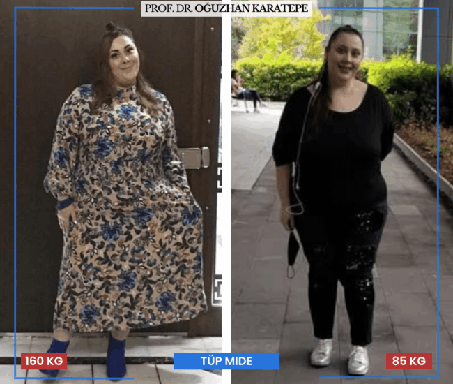 Ameliyat Öncesi Sonrası: Tüp Mide Şikayet ve Yorumlar : Tüp mide ameliyatı öncesi sonrası görüntüleri ve hasta şikayetleri