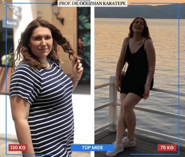 Tüp mide ameliyatı sonrası yorumlar öncesi sonrası hasta deneyimi Tüp mide ameliyatı sonrası yorumlar öncesi sonrası fotoğraf galerisi