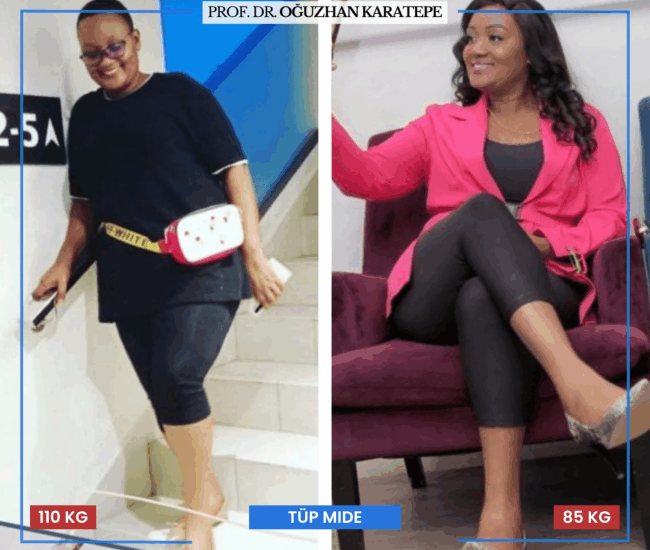 Tüp Mide Ameliyatı Hasta Yorumları ve Deneyimler Ameliyat sonrası tüp mide hasta yorumları