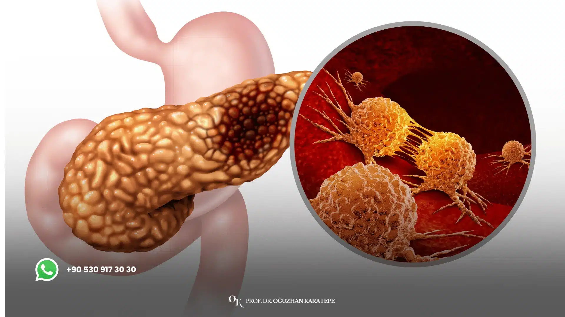 Whipple surgery explained for pancreatic cancer treatment