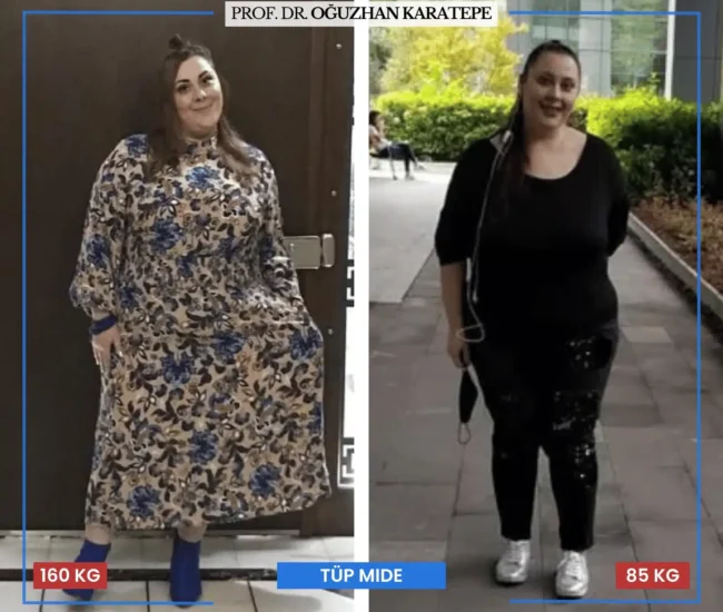 Tüp mide ameliyatı sonrası yorumlar öncesi sonrası dönüşüm Tüp mide ameliyatı sonrası yorumlar öncesi sonrası farkı