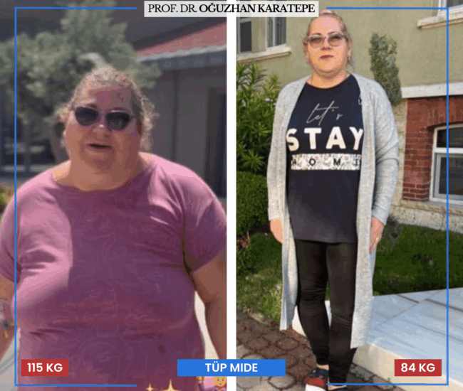 Tüp Mide Öncesi Sonrası Görselleri – Yorumlar ve Değerlendirmeler Obezite ameliyatı öncesi sonrası görselleri ve kullanıcı yorumları
