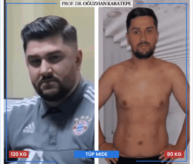 Ameliyat Öncesi Sonrası Hasta Yorumları – Tüp Mide Deneyimi Tüp mide ameliyatı öncesi sonrası hasta memnuniyeti yorumları