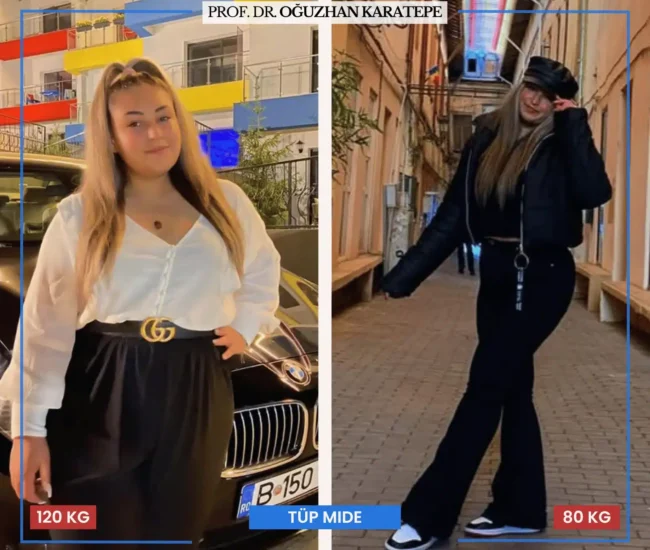 Tüp mide ameliyatı sonrası yorumlar öncesi sonrası etkileri Tüp mide ameliyatı sonrası yorumlar öncesi sonrası sonuçları