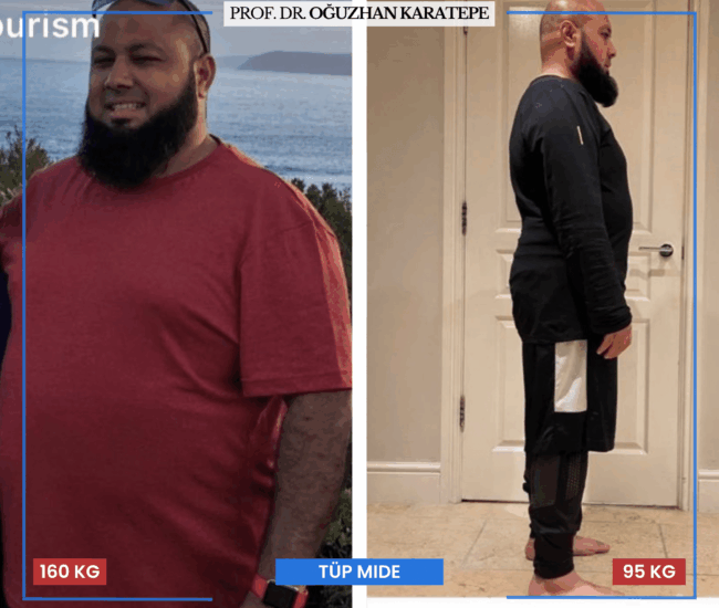 Tüp Mide Sonrası Kilo Verme – Gerçek Hasta Yorumları Tüp mide ameliyatı sonrası kilo verenlerin yorumları