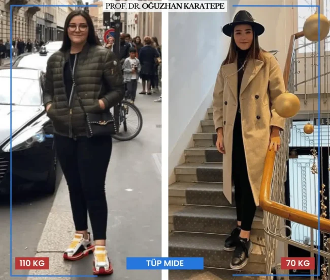 Tüp mide ameliyatı sonrası yorumlar öncesi sonrası Tüp mide ameliyatı sonrası yorumlar öncesi sonrası fotoğraf