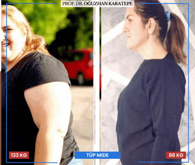 Tüp Mide Sonrası En Sık Yaşanan Şikayetler Obezite ameliyatı sonrası en çok paylaşılan şikayetler