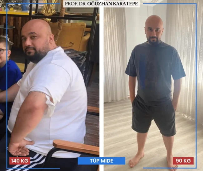 Tüp mide ameliyatı sonrası yorumlar öncesi sonrası kilo kaybı Tüp mide ameliyatı sonrası yorumlar öncesi sonrası süreç