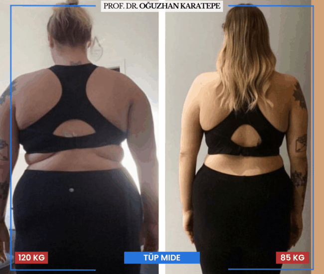 Fiziksel Dönüşüm: Obezite Ameliyatı Öncesi ve Sonrası Tüp mide ameliyatı öncesi sonrası yaşanan fiziksel değişimler