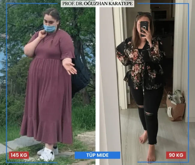 Tüp mide ameliyatı sonrası yorumlar öncesi sonrası görselleri Tüp mide ameliyatı sonrası yorumlar öncesi sonrası değişim