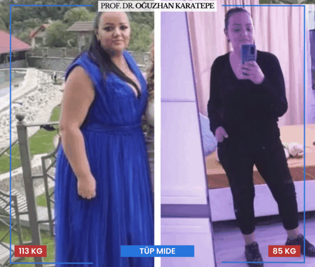 Tüp Mide Ameliyatı Sonrası Olumsuz Yorumlar ve Şikayetler Tüp mide ameliyatı sonrası memnun olmayan hastaların şikayetleri