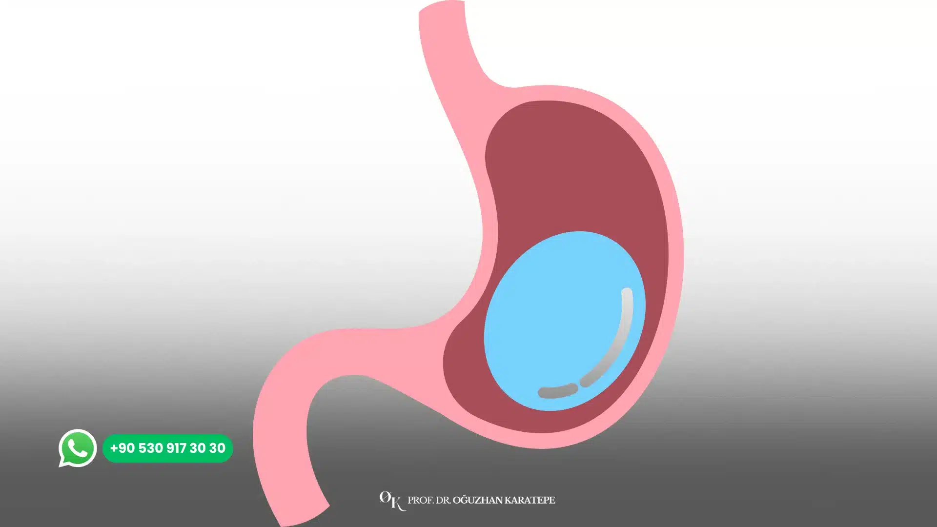 Scientific article on gastric balloon weight loss by Oğuzhan Karatepe