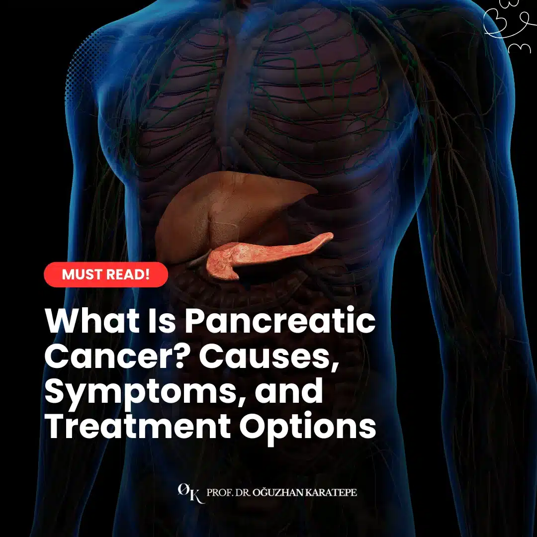 What Is Pancreatic Cancer? Causes, Symptoms, and Treatment Options
